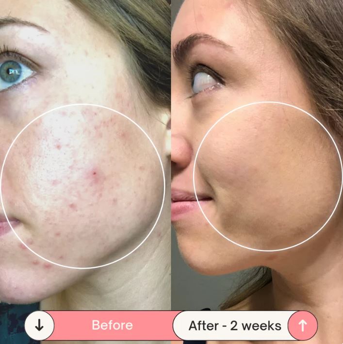 NeuroGlow™ - High Frequency Wand